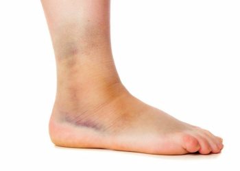 Những bộ phận dễ bị bong gân