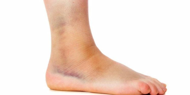 Những bộ phận dễ bị bong gân