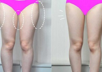 Nguyên nhân mỡ tích tụ trên đùi của bạn