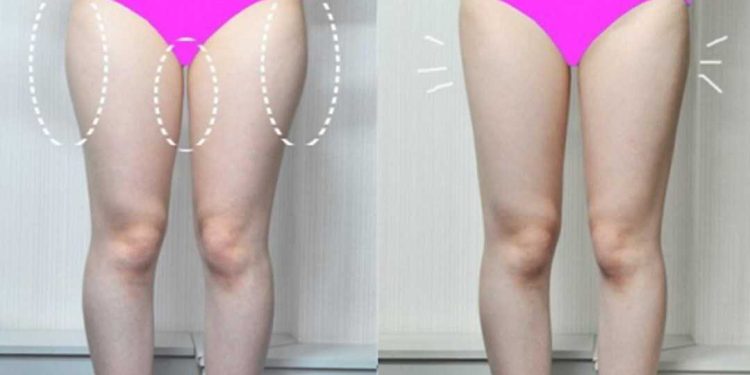 Nguyên nhân mỡ tích tụ trên đùi của bạn