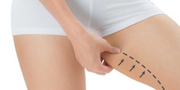 Giảm mỡ đùi nhanh chóng với 3 cách sau